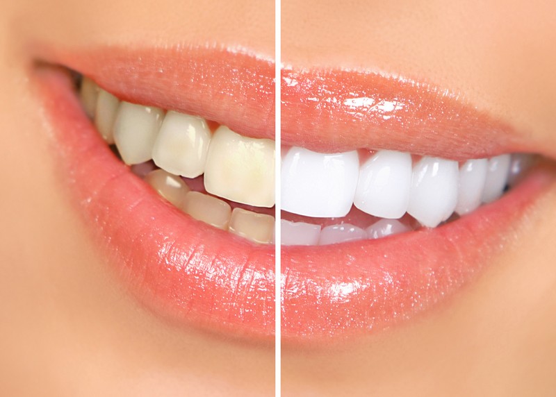 Teeth Whitening  Duluth, MN