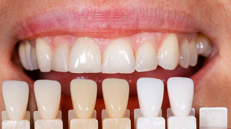 Veneers  Duluth, MN